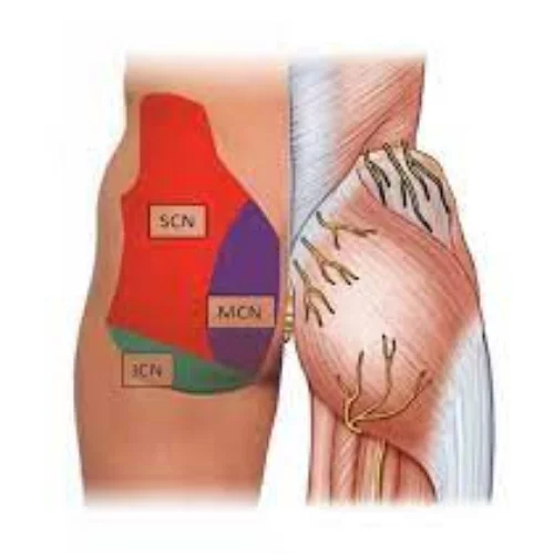 Cluneal Nerve Entrapment