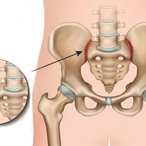 Sacroiliac Joint Dysfunction