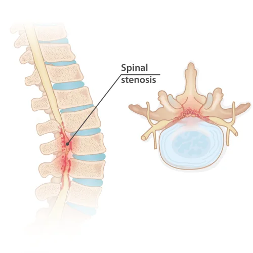 Spinal Stenosis