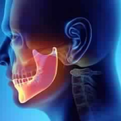 Temporomandibular Joint Syndrome