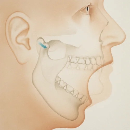 Temporomandibular Joint Syndrome