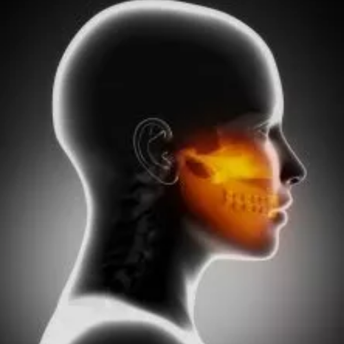 Trigeminal Neuralgia