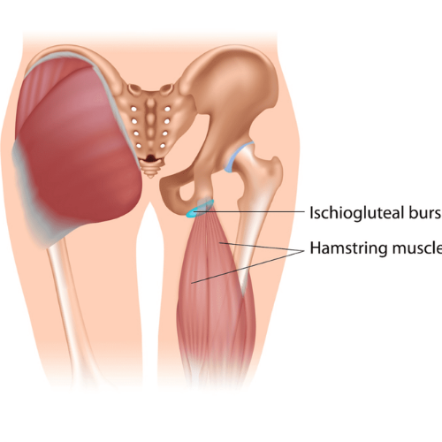 Lateral Hip Pain