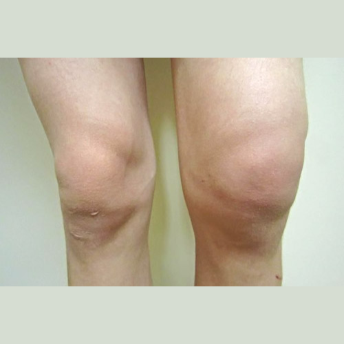 knee-bursitis2