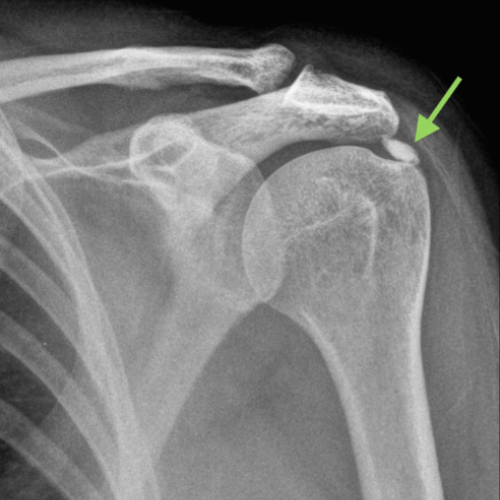 Calcific Tendinitis