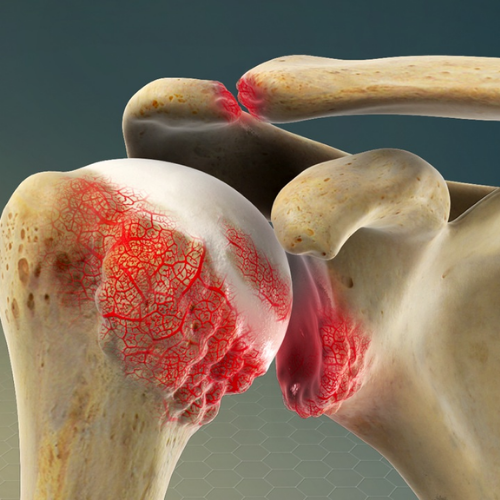 Shoulder Joint Arthritis