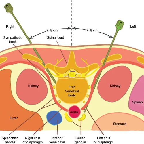 CELIAC PLEXUS BLOCK