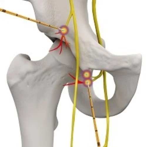 cooled-radiofrequency-ablation  