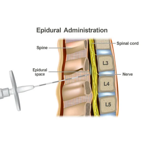 epidural-injections