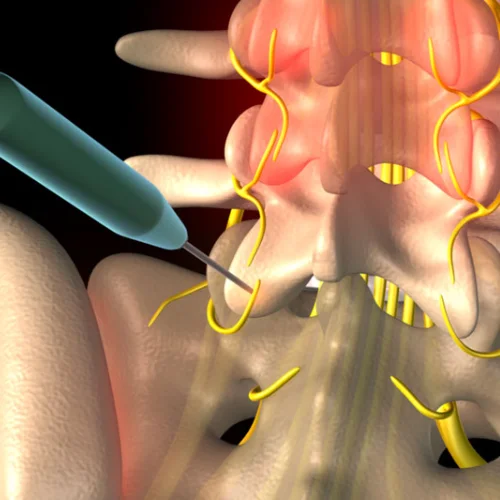 lumbar-facet-radiofrequency-ablation