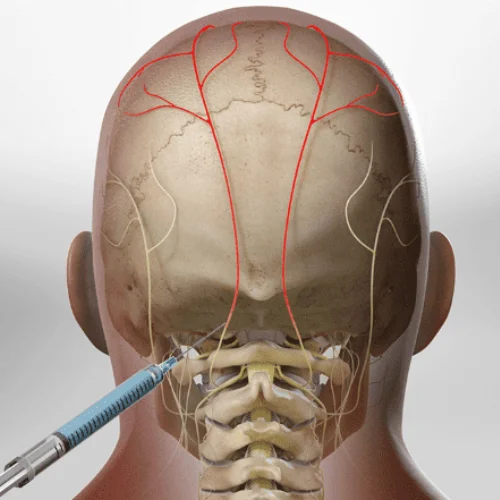 OCCIPITAL NERVE BLOCK