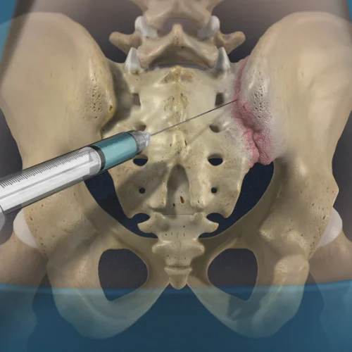 sacroiliac-joint-injections