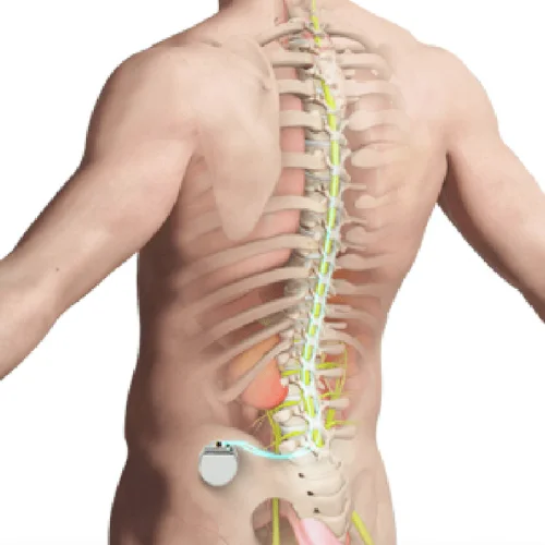 spinal-cord-stimulation