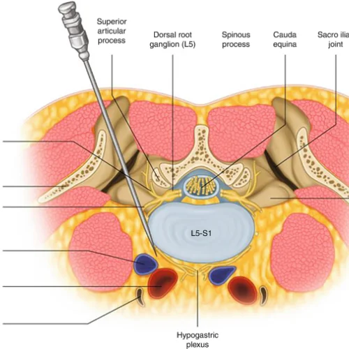 SUPERIOR HYPOGASTRIC PLEXUS BLOCK