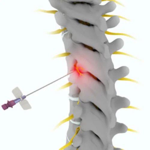 thoracic-injections