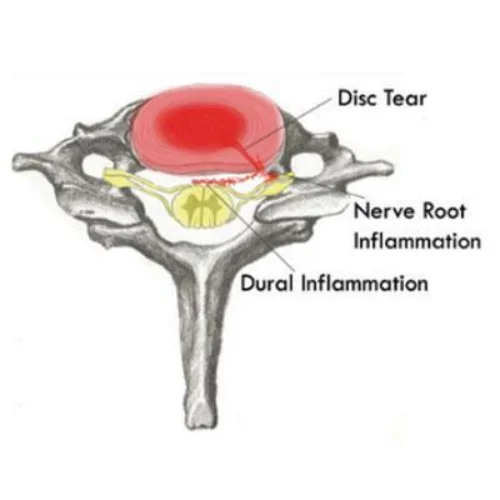 transforaminal-injections