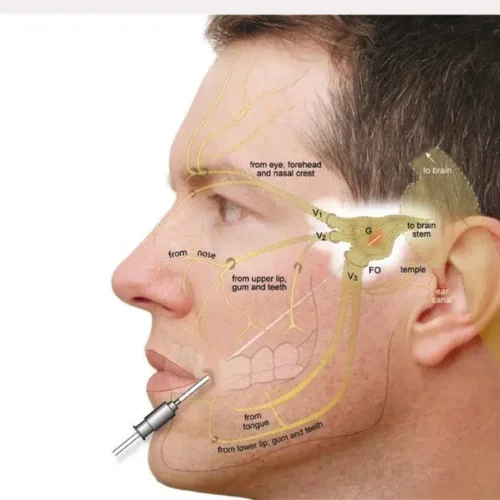 trigeminal-neuralgia-radiofrequency-ablation