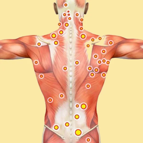 trigger-point-injections